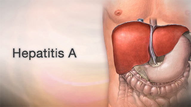 Hepatitis A