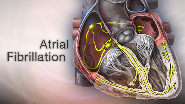 Atrial fibrillation