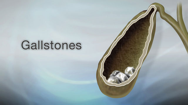 Gallstones