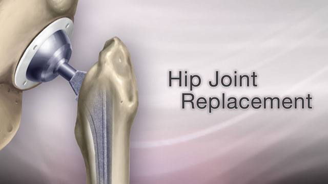 Hip joint replacement Information