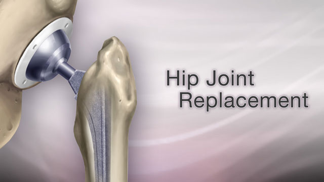 Hip joint replacement