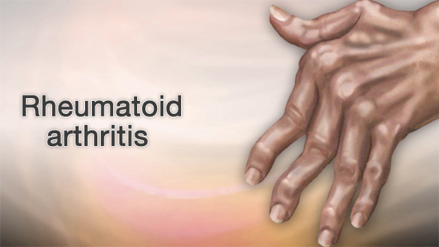 Rheumatoid arthritis