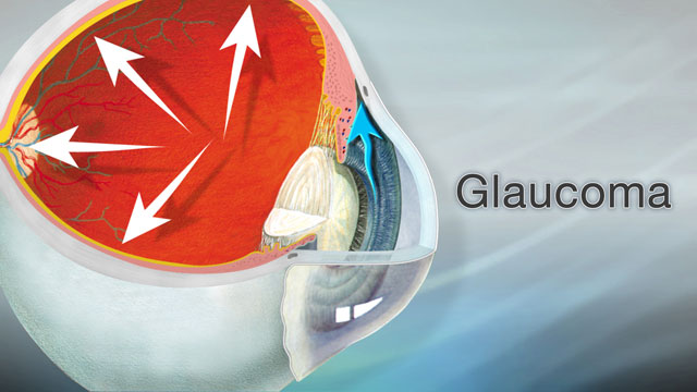 Glaucoma