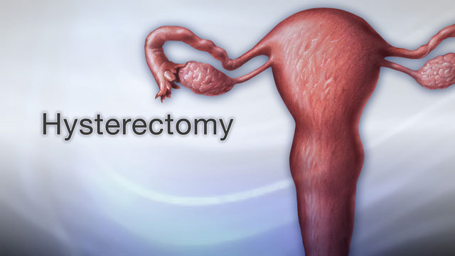 Women's health—hysterectomy - Patient Information Brochures - Mater Group
