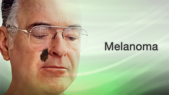 Melanoma