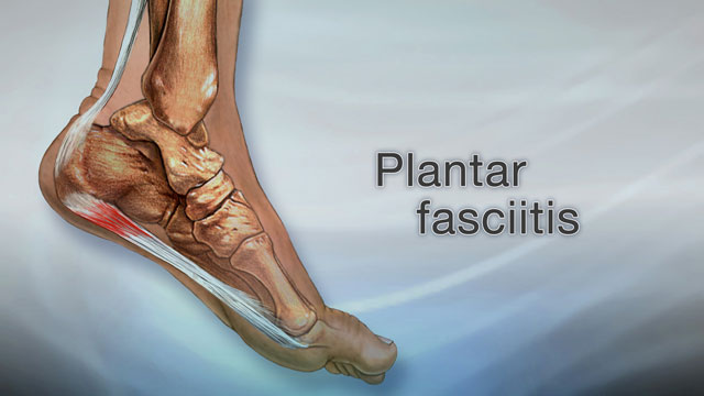 Plantar fasciitis