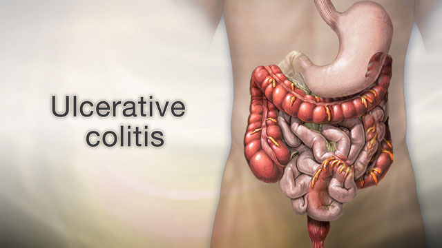 Ulcerative colitis