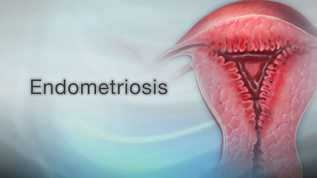 Endometriosis