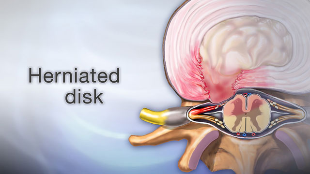 Herniated disk