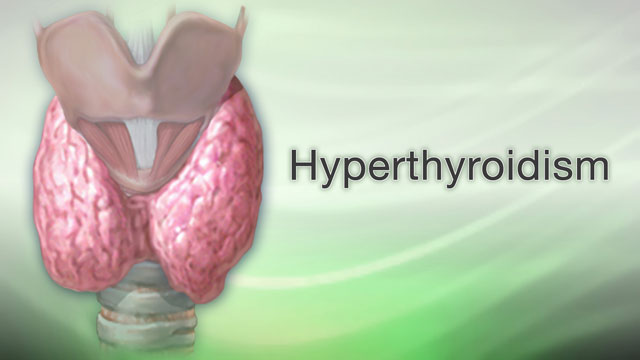 Hyperthyroidism