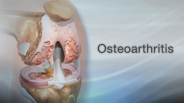 Osteoarthritis