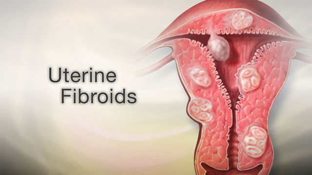 Uterine fibroids