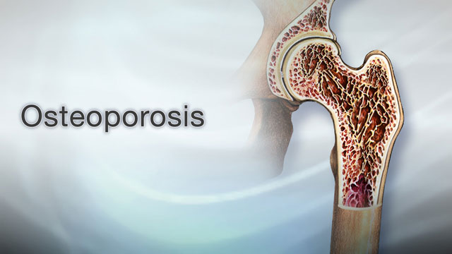 Osteoporosis