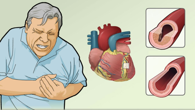 Angina causes and symptoms