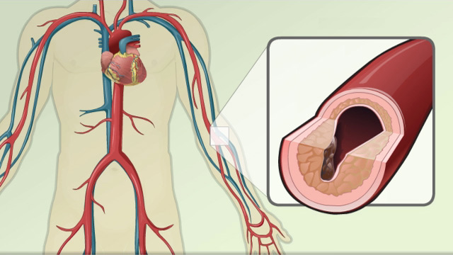 Atherosclerosis causes