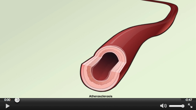 Atherosclerosis overview