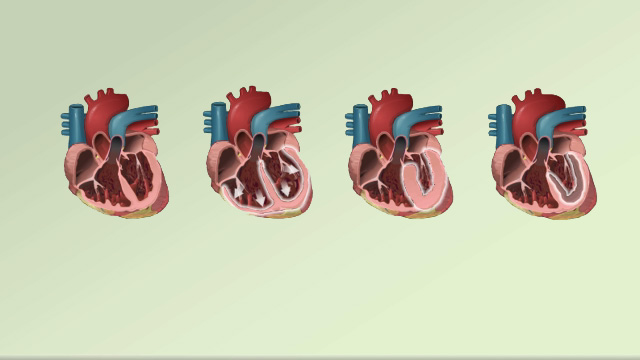 Cardiomyopathy overview