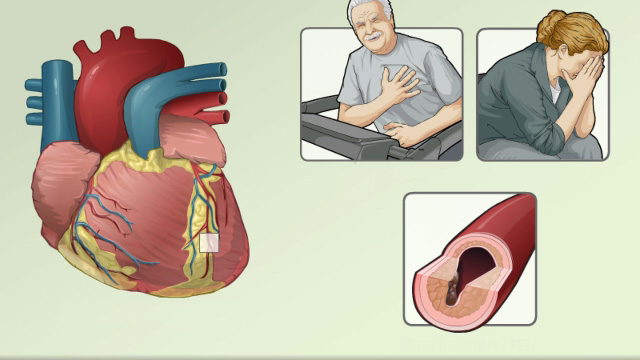 Angina pectoris treatment