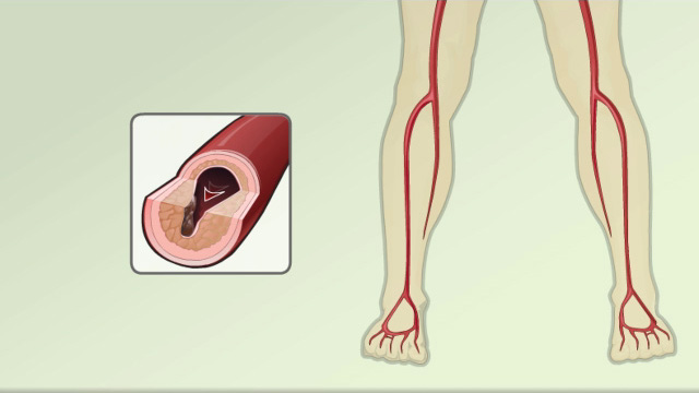 Peripheral artery disease (PAD) - overview 