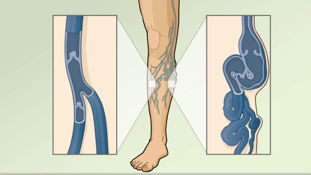 Varicose veins overview