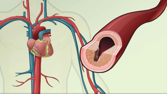 Cardiovascular disease - description