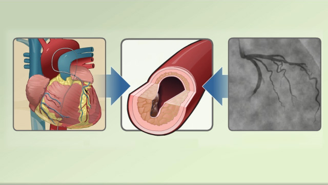 Cardiac catheterization - uses in diagnosis, evaluation and treatment