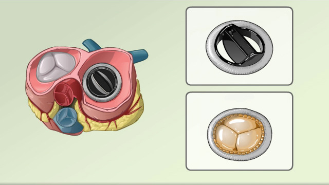 Heart valve replacement - overview