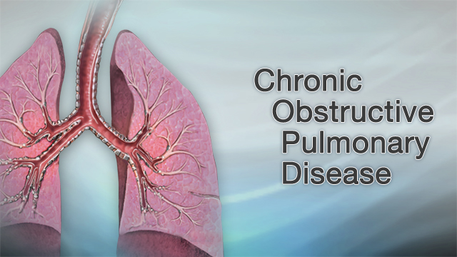 Chronic obstructive pulmonary disease