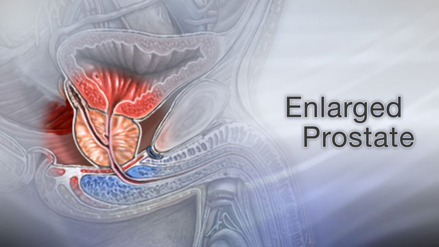 Enlarged prostate Information Mount Sinai New York