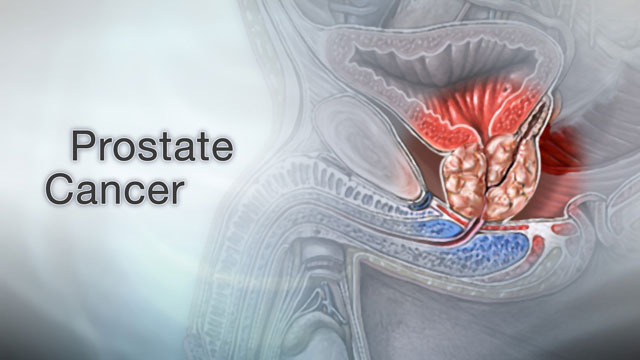 Prostate cancer