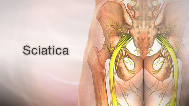 Sciatica