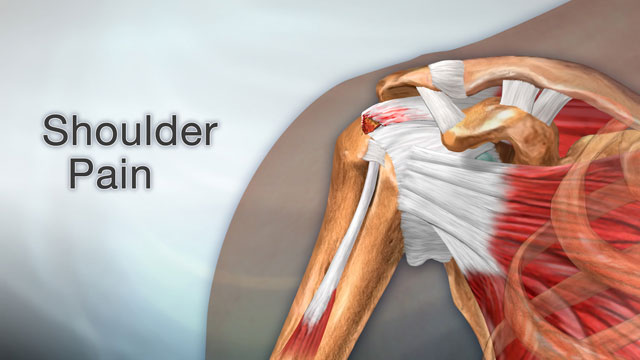 Shoulder Pain - Symptoms and Causes