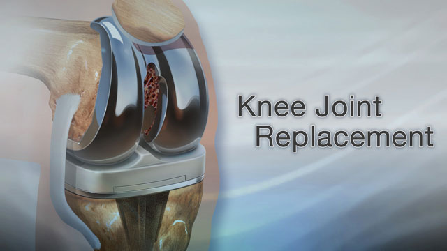 Knee joint replacement