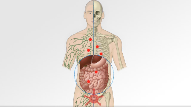 How cancer spreads through the body