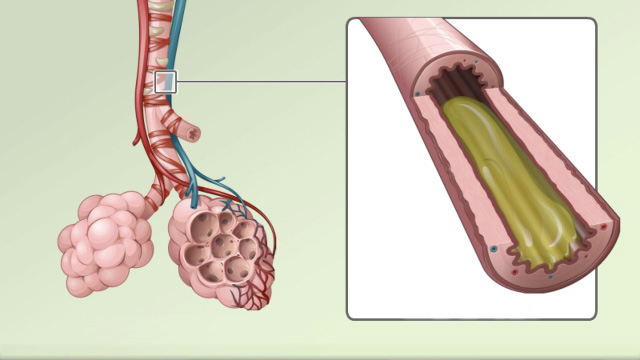 Your lungs: The inflammatory response