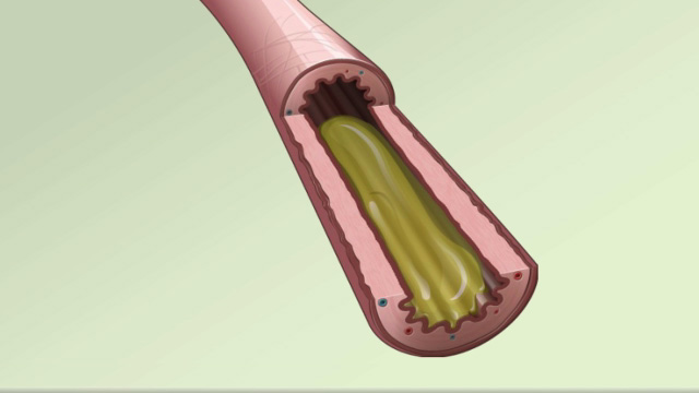 The inflammatory response: Symptoms and causes of airflow limitation