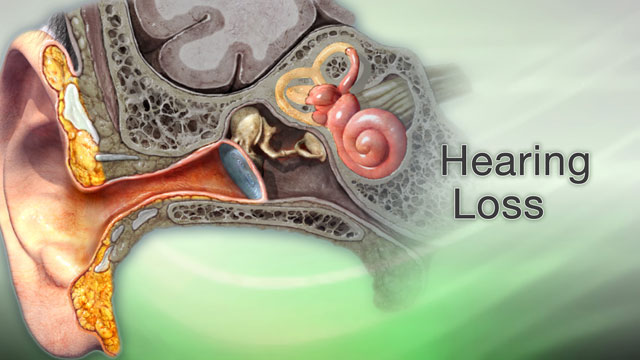 Hearing loss