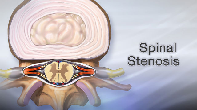 Spinal stenosis