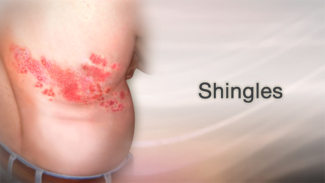 Shingles