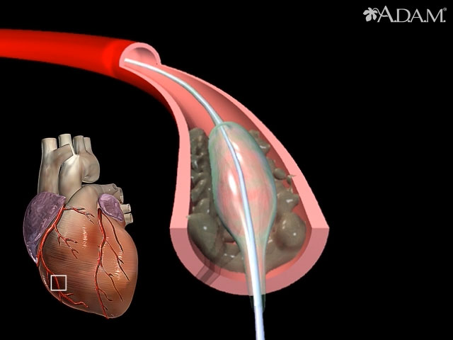 Angioplastia con balón - segmento corto