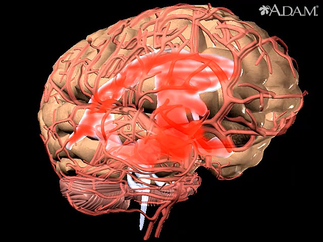 Aneurisma cerebral