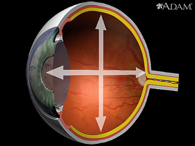 Glaucoma