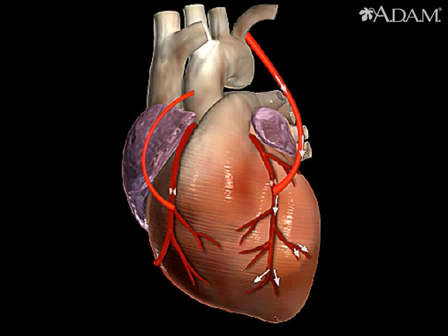 Cirugía de derivación cardíaca
