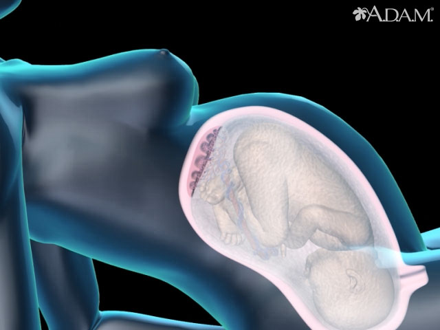 Preeclampsia