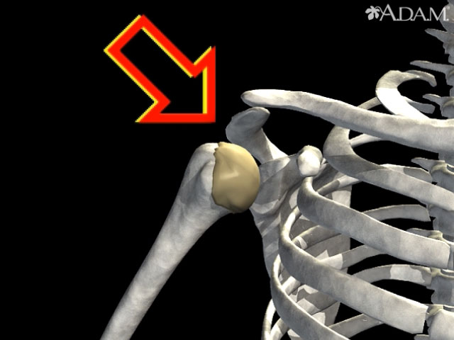 Dislocación de articulación del hombro