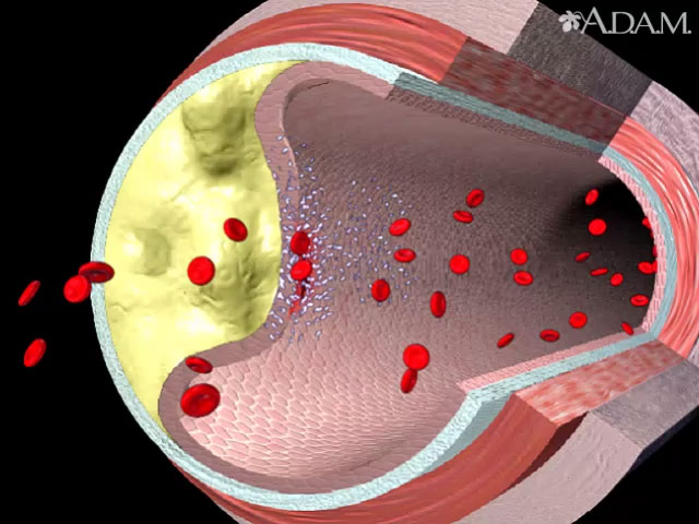 Accidente cerebrovascular