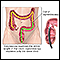 <div class=media-desc><strong>Colonoscopy</strong><p>There are 3 basic tests for colon cancer; a stool test (to check for blood), sigmoidoscopy (inspection of the lower colon), and colonoscopy (inspection of the entire colon). All 3 are effective in catching cancers in the early stages, when treatment is most beneficial.</p></div>