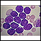 Leucemia linfocítica aguda - fotomicrografia