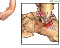 Lesión en los ligamentos del tobillo - Animación
                    