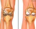 Osteoarthritis - Animation
                    